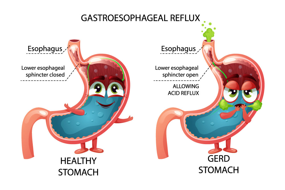 gastroprottetori 3