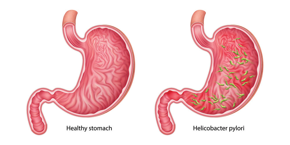 Helicobacter 2