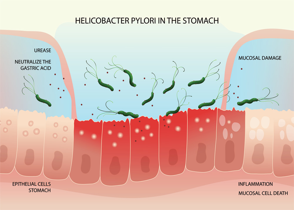 Helicobacter 4